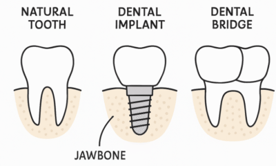 dental implants