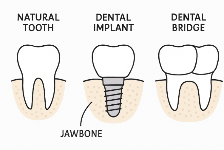 dental implants