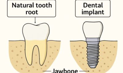 Dental Implants