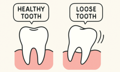 Loose Teeth