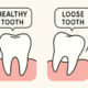 Loose Teeth