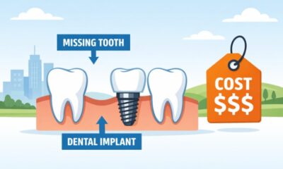 Dental Implants