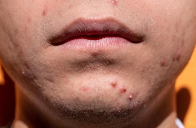 Acne Treatments