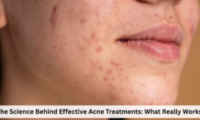 Acne Treatments
