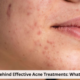 Acne Treatments