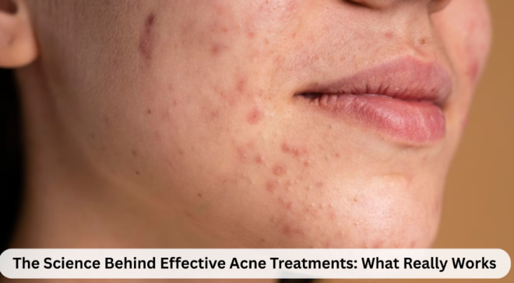Acne Treatments