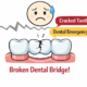 Dental Bridge