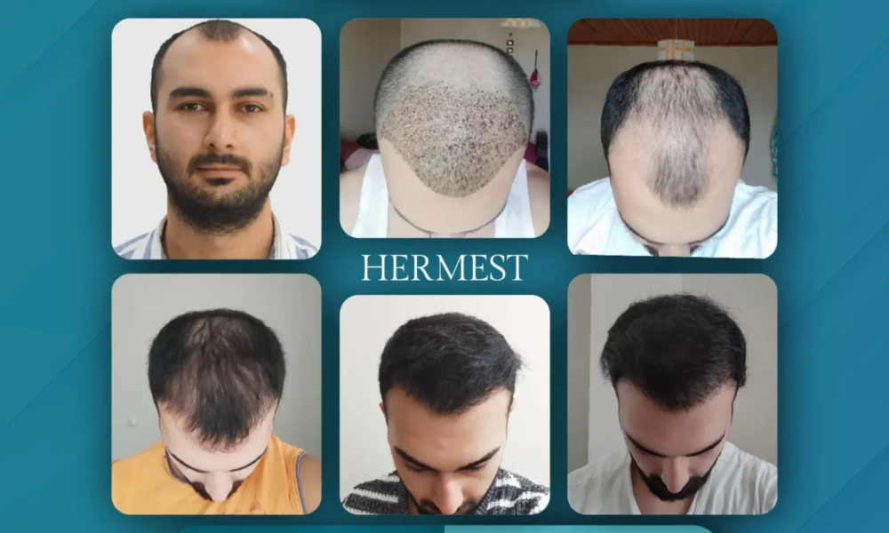 Hair Transplant Clinic in Turkey