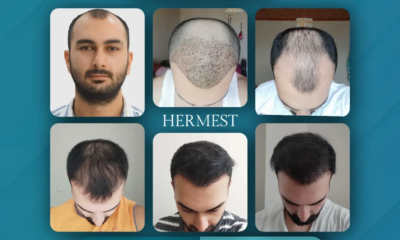 Hair Transplant Clinic in Turkey