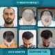 Hair Transplant Clinic in Turkey