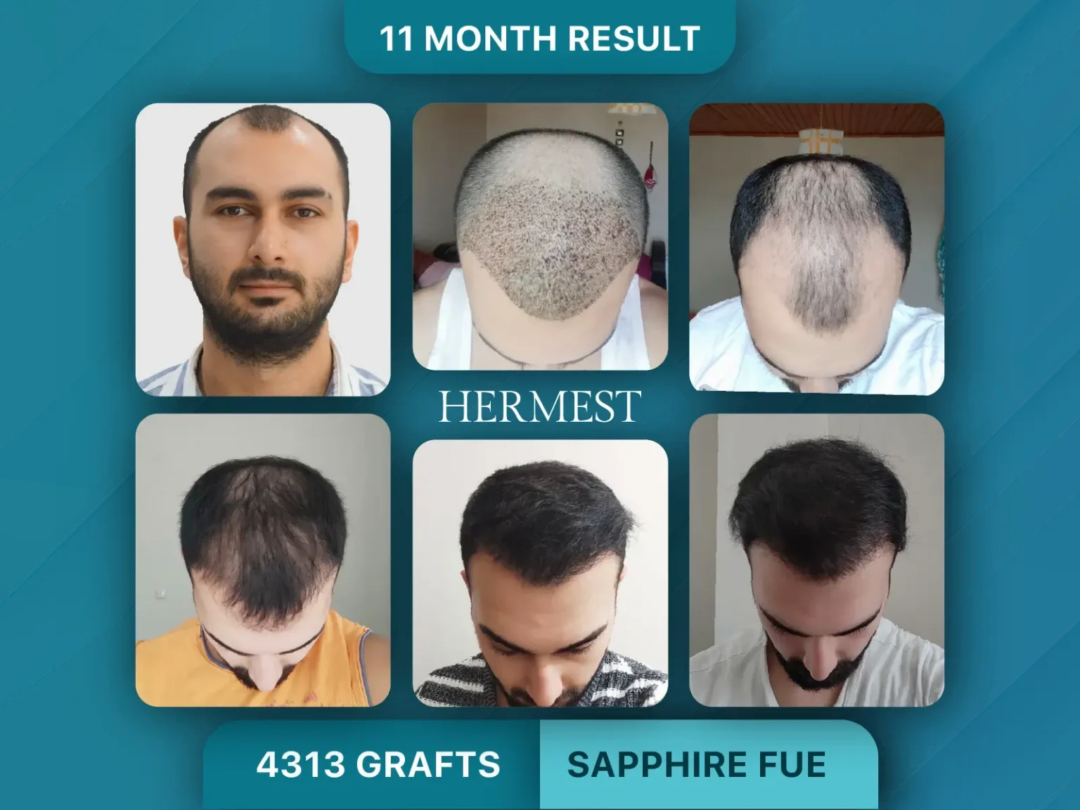 Hair Transplant Clinic in Turkey