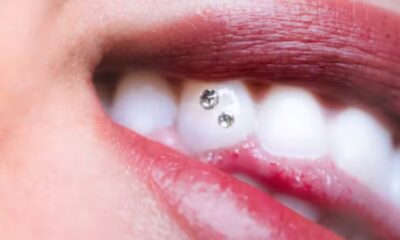 Tooth Gems 101