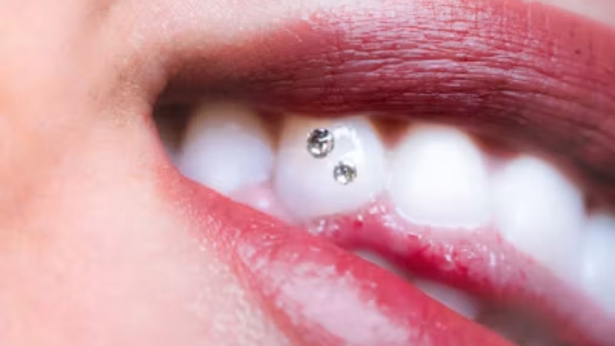 Tooth Gems 101